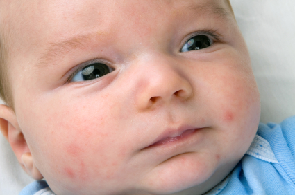 Sarpullido por calor en bebés y niños: ¿cómo evitarlo? 