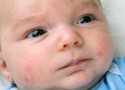 Sarpullido por calor en bebés y niños: ¿cómo evitarlo? 